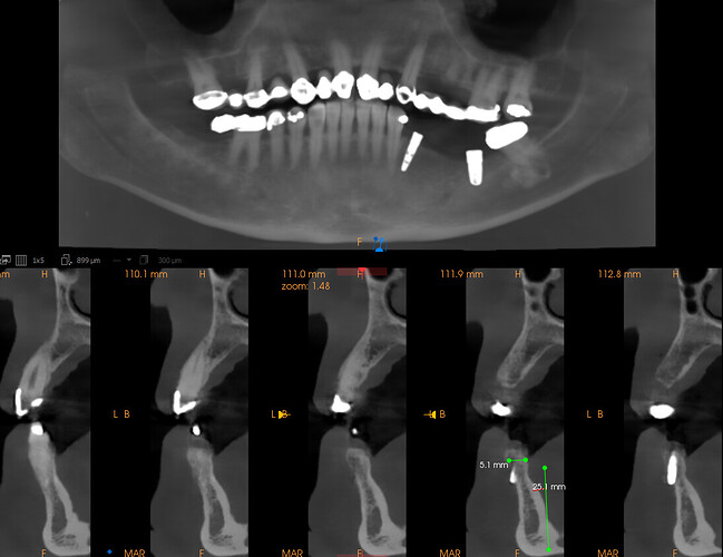 implant2